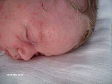 Fot. Mloda, Problemy skorne u noworodka