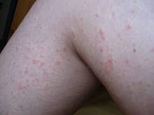 Fot. Ewelinka_inka, z czego ta wysypka?? pomocy      Alergia?
